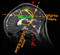 Anatomical MRI of one subject illustrating the two alternative slice orientations chosen for functional imaging