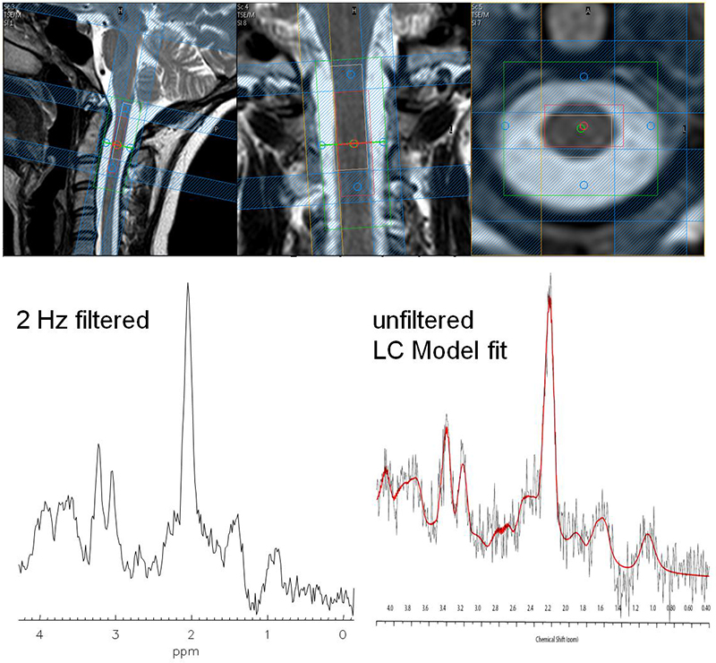 Enlarged view: Spinal cord MRS in a healthy volunteer