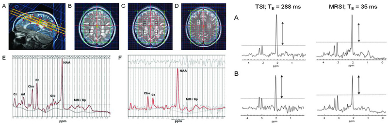 Enlarged view: MRSI in CADASIL